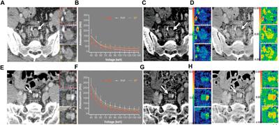 Application of spectral CT in diagnosis, classification and prognostic monitoring of gastrointestinal cancers: progress, limitations and prospects